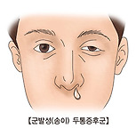 군발성 두통 증후군