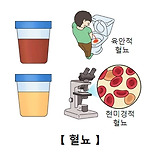 발작성야간혈색뇨