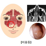 비용종