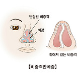 비중격 만곡