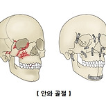 안와 골절