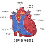 동맥관 개존증