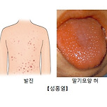 성홍열