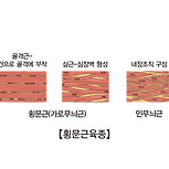 횡문근육종