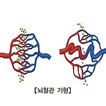 뇌 동정맥 기형