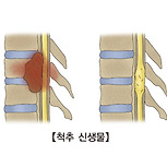 척추 종양