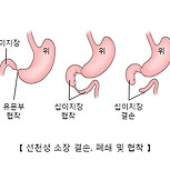 선천성 소장 결손, 폐쇄 및 협착