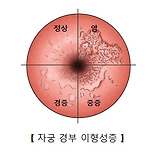 자궁 경부의 이형성증