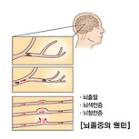 뇌졸중