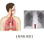 양성 종격동 종양