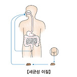 세균성 이질