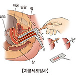 자궁경부염