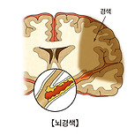 뇌경색