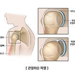 관절와순 파열