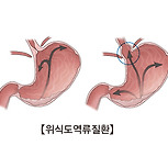 위식도 역류성 질환