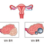 난소암