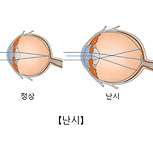 난시