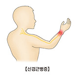 신경근병증