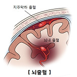 뇌출혈