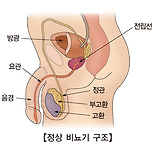 고환 종양