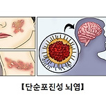 단순 포진성 뇌염