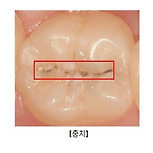 치아 우식증[충치]