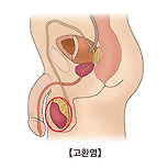 고환염