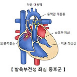 발육부전성 좌심 증후군