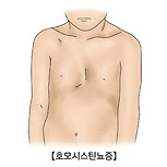 호모시스틴뇨증