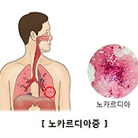 노카르디아증