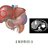 간경화