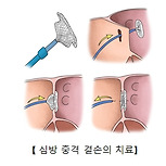 심방 중격 결손