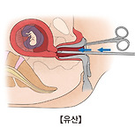 절박 유산