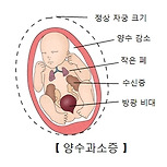 양수과소증