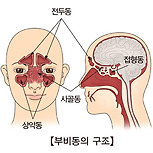 부비동염