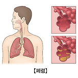 폐렴