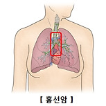 흉선암