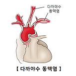 타카야수 혈관염