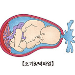 조기 양막 파열