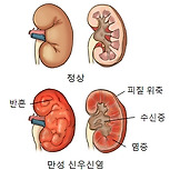 만성 신우신염