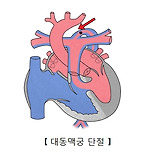 대동맥궁 단절