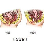 방광탈