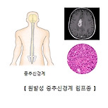 원발성 중추신경계 림프종