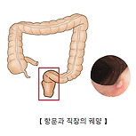 항문 및 직장의 궤양