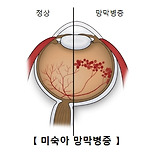 미숙아 망막병증