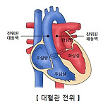 대혈관 전위