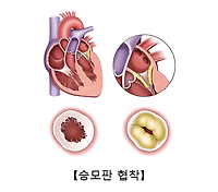 승모판 협착