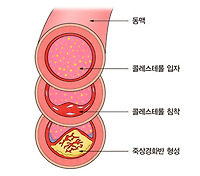 이상지질혈증