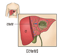 간농양