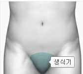 생식기 부종